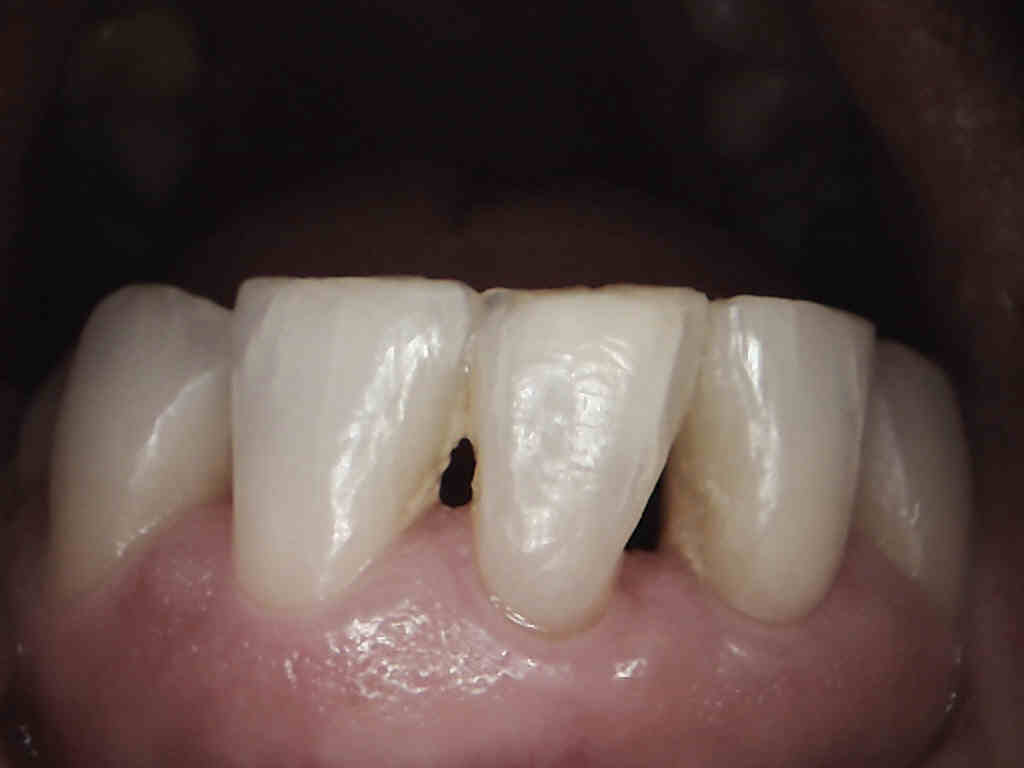 Black Triangle Teeth